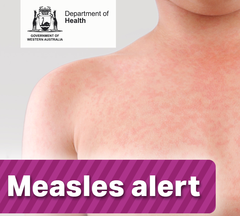 Measles alert