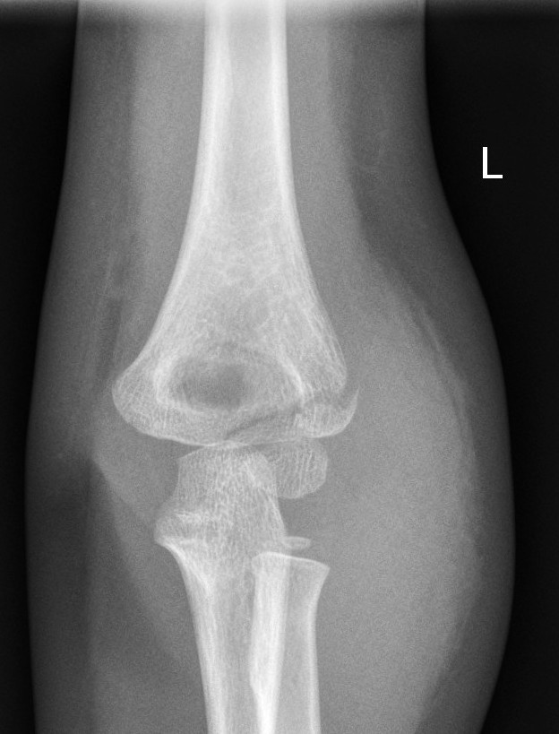 Lateral condyle fracture