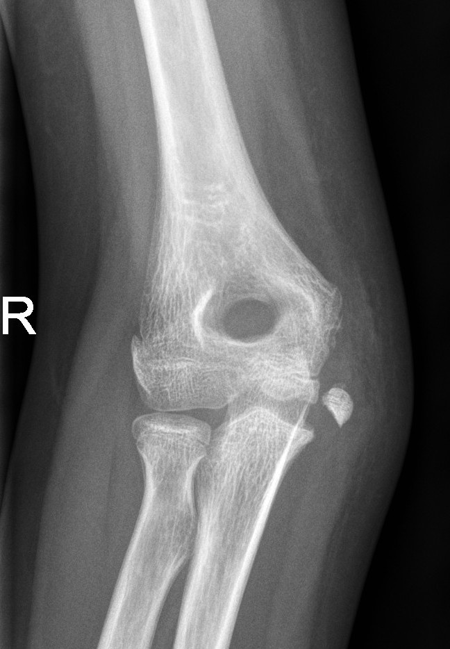 Displaced medial epicondyle