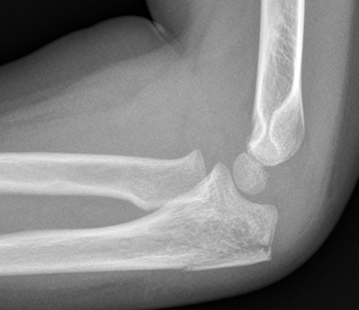 Non-displaced Olecranon fracture