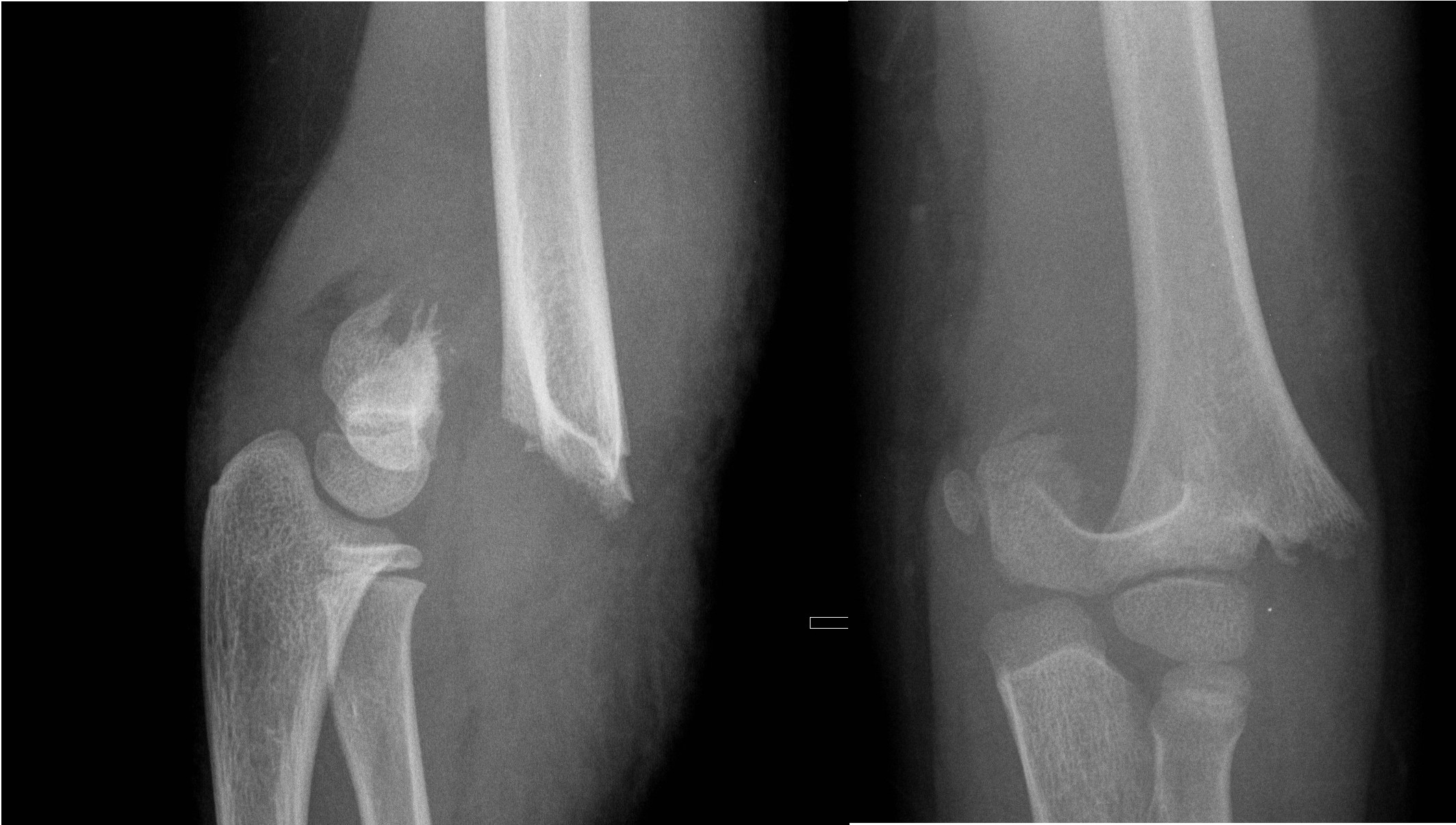 Displaced supracondylar fracture